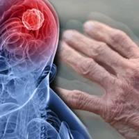 Parkinson Tedavisi Parkinson Tedavisi