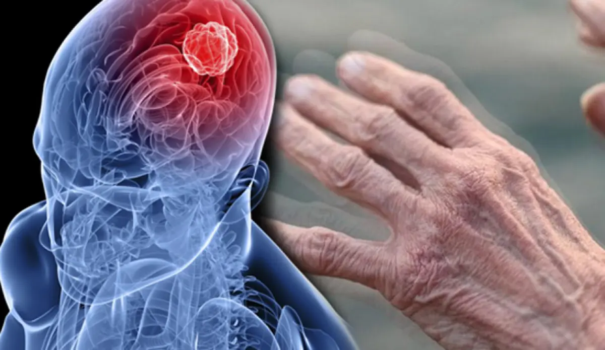 Parkinson Tedavisi